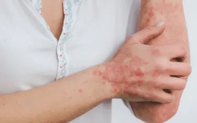 Le psoriasis : un dysfonctionnement corps/esprit