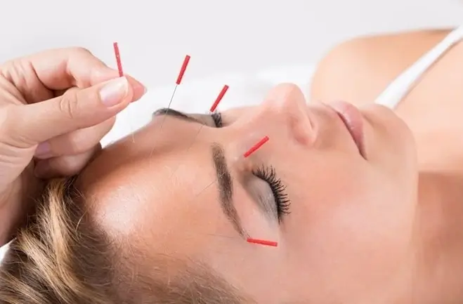Une femme recevant de l'acupuncture sur le visage Une femme recevant de l'acupuncture sur le visage