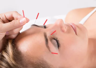 A woman receiving acupuncture for allergies