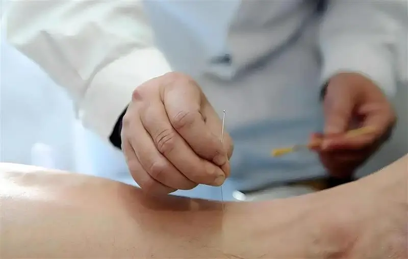 Un homme recevant de l'acupuncture pour la transpiration Un homme recevant de l'acupuncture pour la transpiration