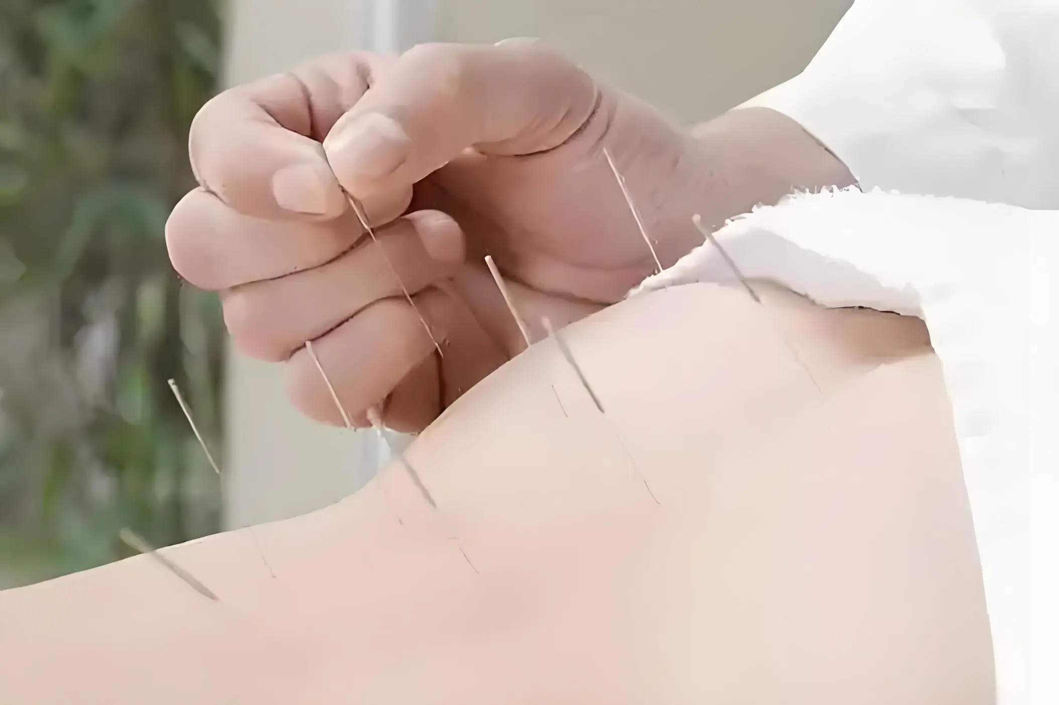 Une femme recevant de l'acupuncture pour la PMA