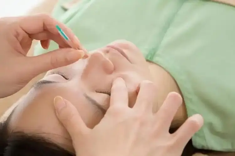 Une femme recevant de l'acupuncture pour les allergies Une femme recevant de l'acupuncture pour les allergies